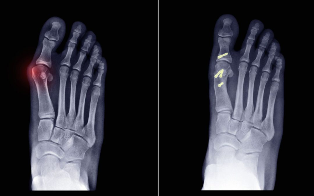 Chirurgie Mini-Invasive pour l’Oignon du Pied